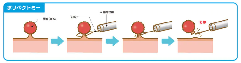 ポリペクトミーのイメージ図